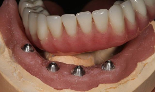 Front Teeth Dentures Wonder Lake IL 60097